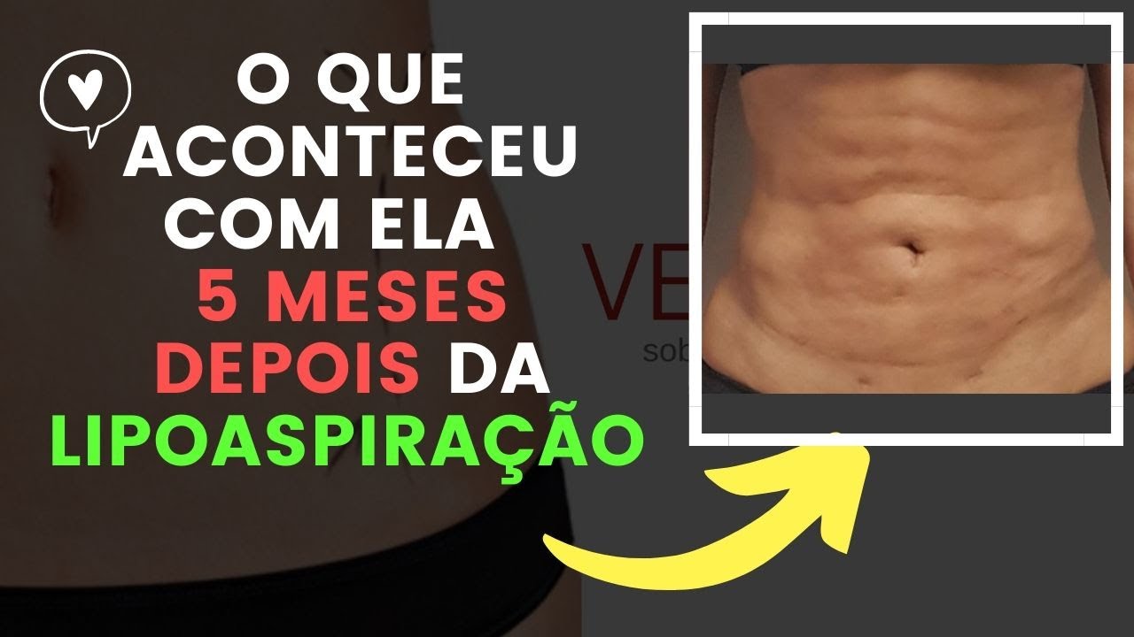 Tratamento para fibroses pós lipo e abdominoplastia: Entenda o que aconteceu com ela 5 MESES depois!