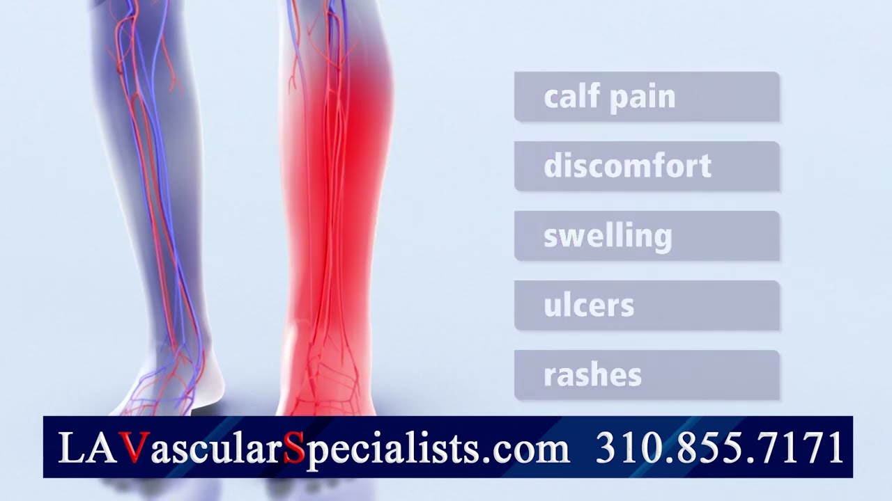 Post thrombotic syndrome PTS can be a consequence of DVT