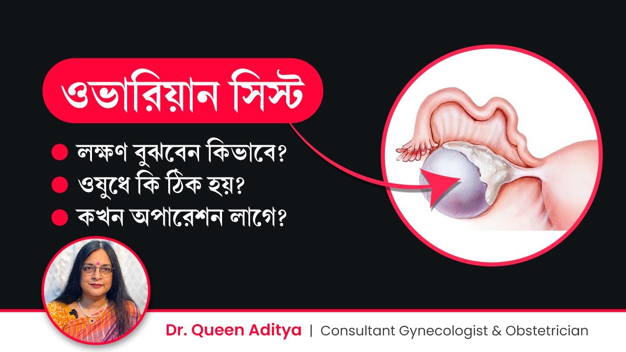 ওভারিতে সিস্ট হলে কি সমস্যা হয়? ওষুধে ঠিক হয় নাকি অপারেশন লাগে? Ovarian Cyst Symptoms & Treatment