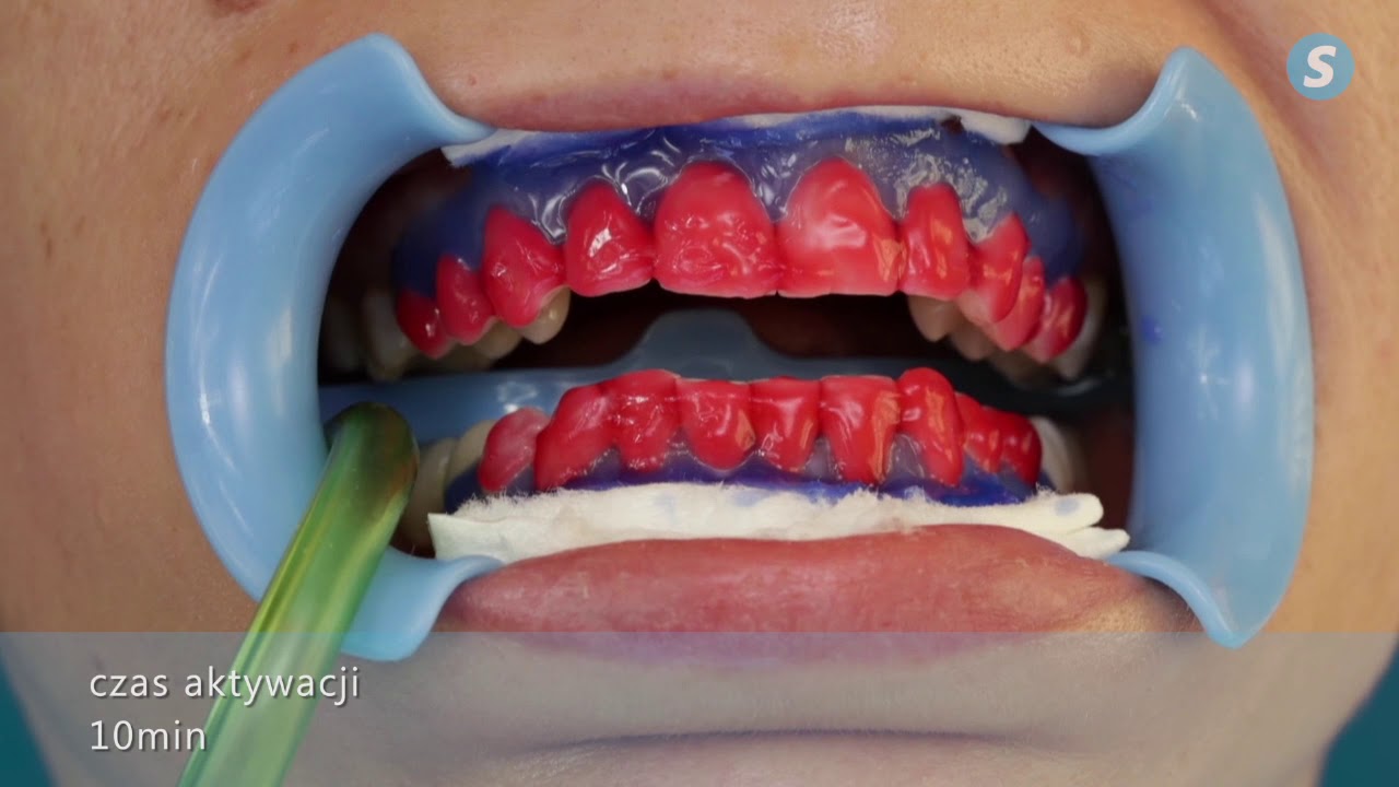 Wybielanie laserowe dentystyka