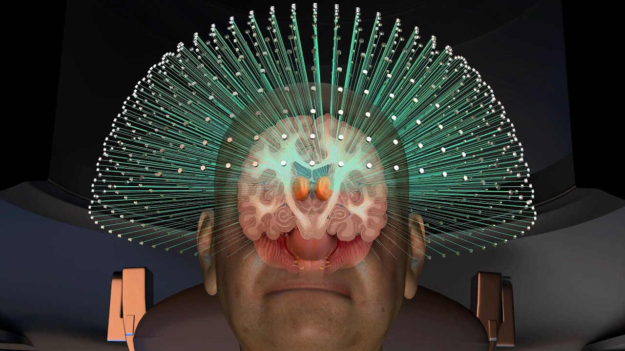 Focused Ultrasound Treatment for Essential Tremor  |  UCSF Neurosurgery