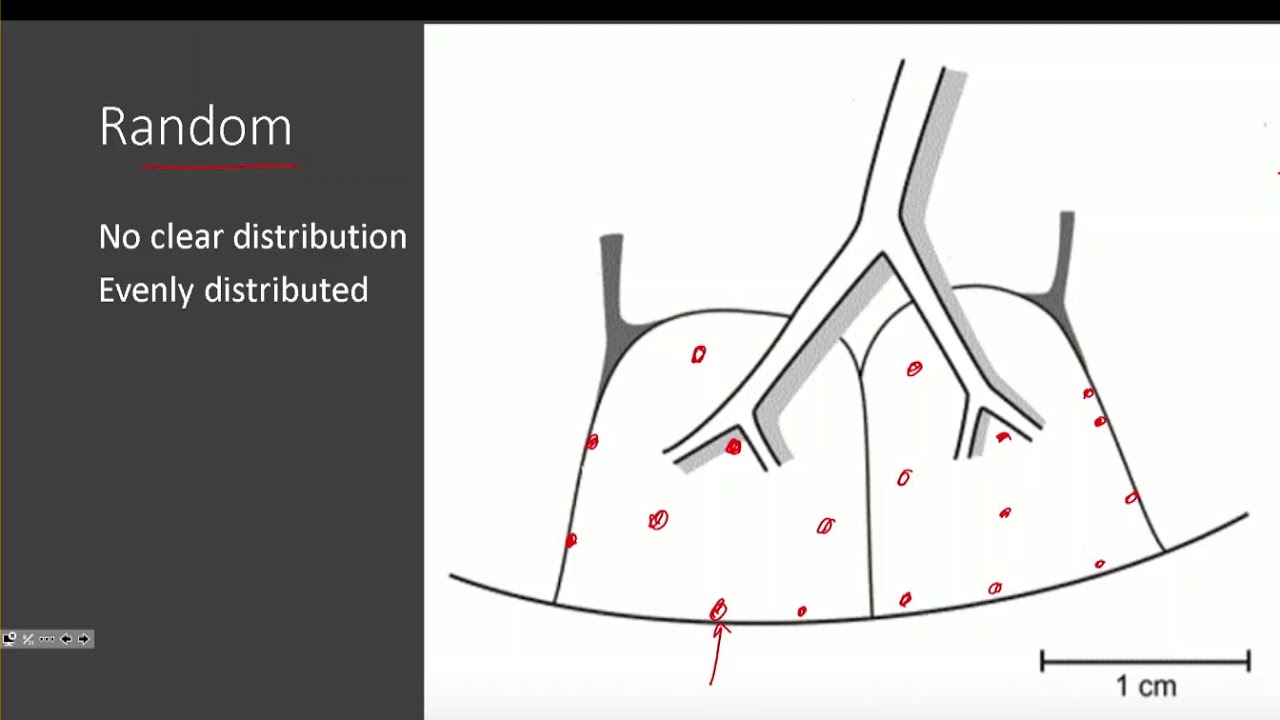 Micronodular Lung Disease Part 1