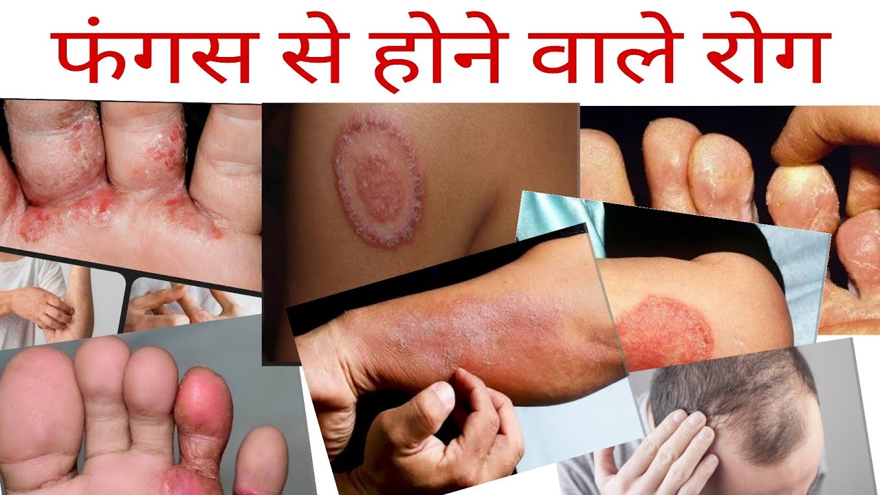 फंगस से होने वाले रोग | कारण, लक्षण और बचाव | स्वास्थ्य जानकारी