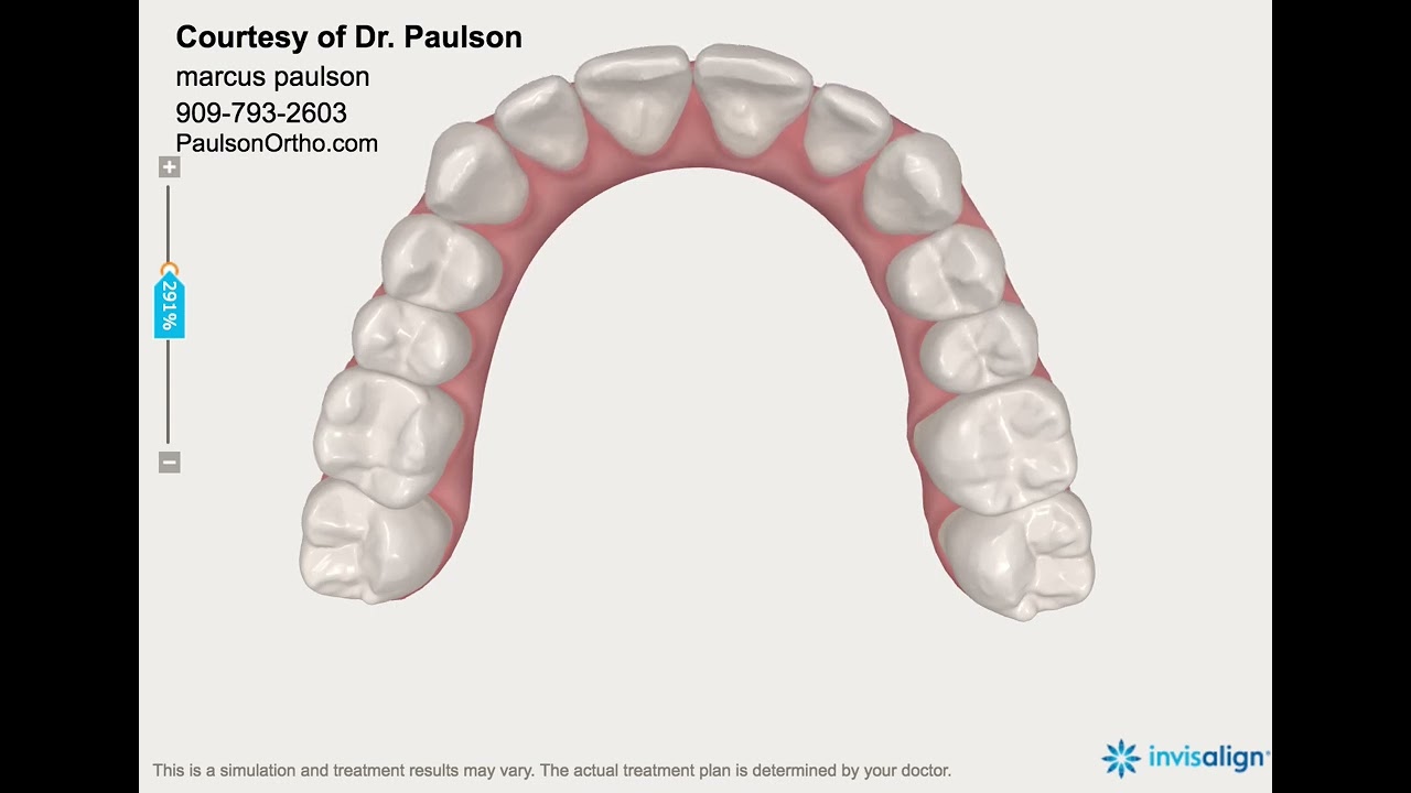 Invisalign Simulation - Moderate Crowding