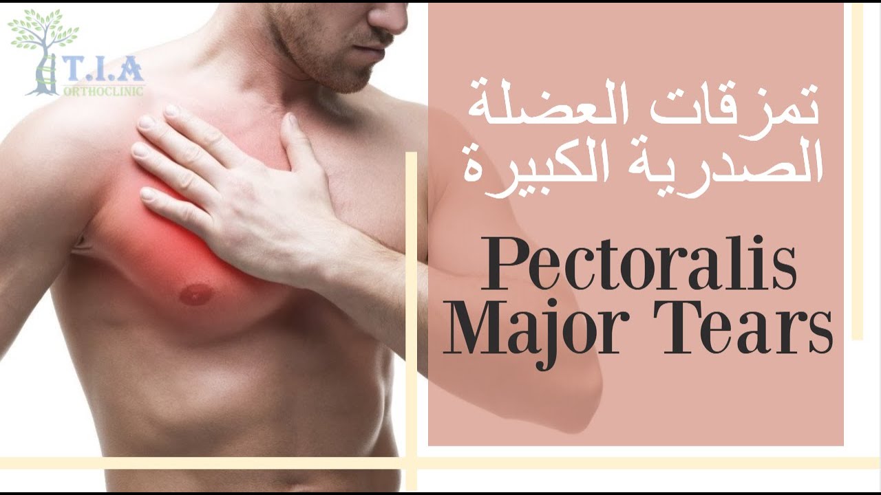 تمزق العضلة الصدرية الكبيرة     pectoralis major tear (subtitled)