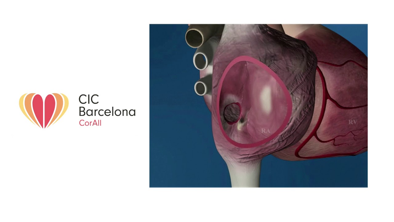Tricuspid Atresia