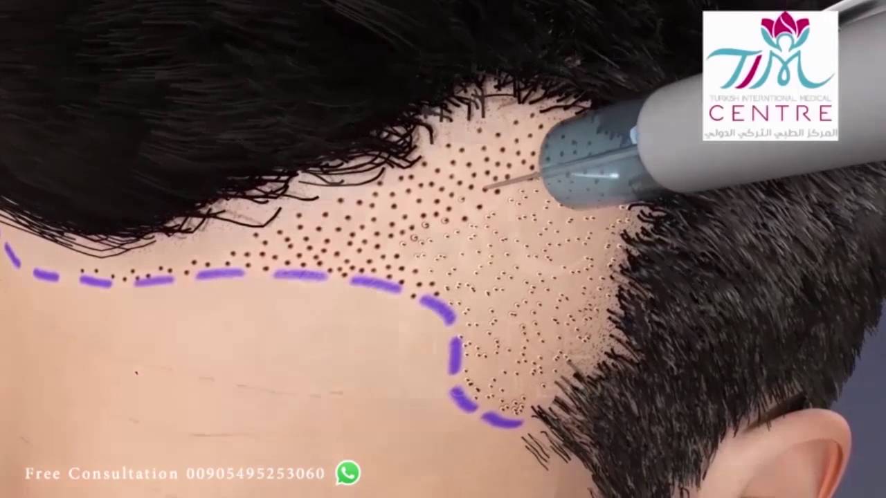 مراحل زراعة الشعر