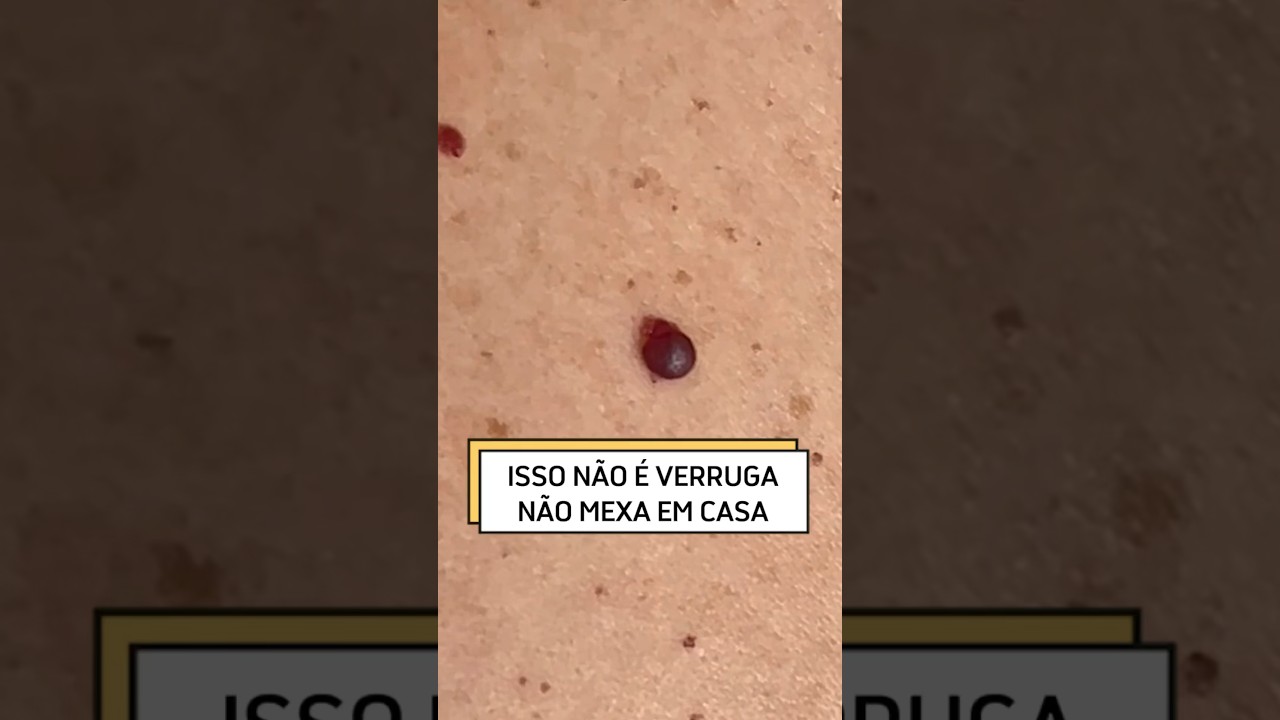Este é o nevo rubi. É um vaso que cresceu. Você não deve mexer em casa pois sangra muito.