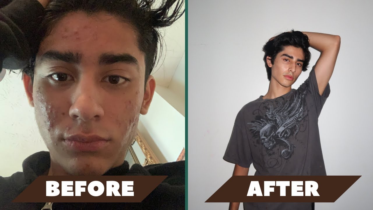 My Accutane journey