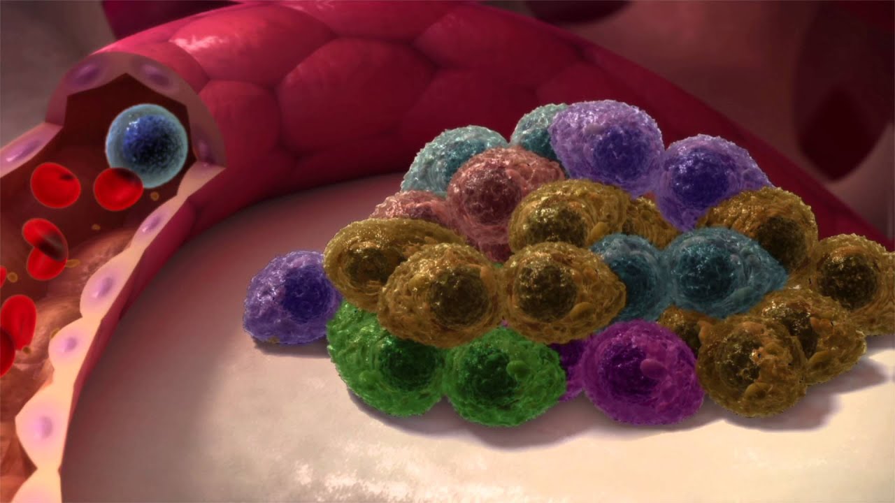 Clonal evolution: the changing nature of myeloma