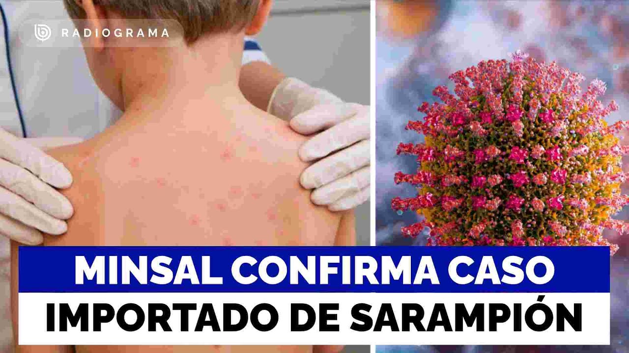 Minsal confirma caso importado de sarampión en un lactante: estuvo recientemente en México