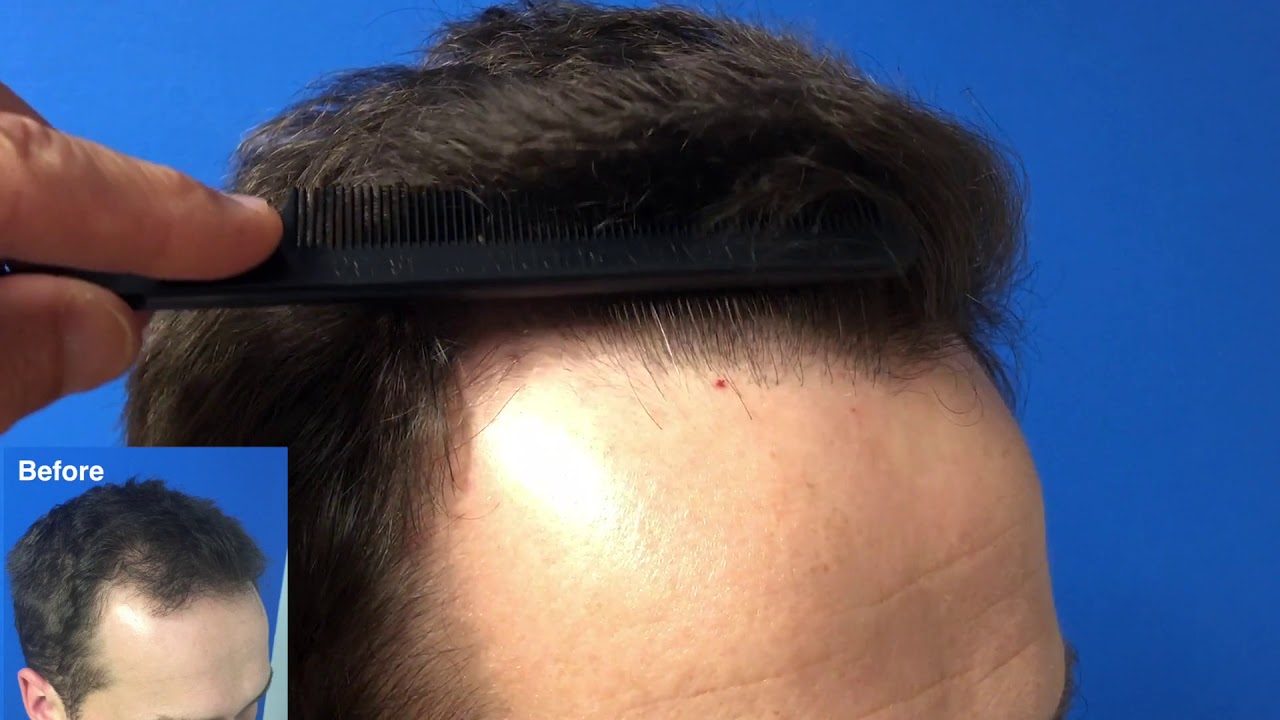 Hair Transplant Case Study and Combthrough   Hartford, CT 1
