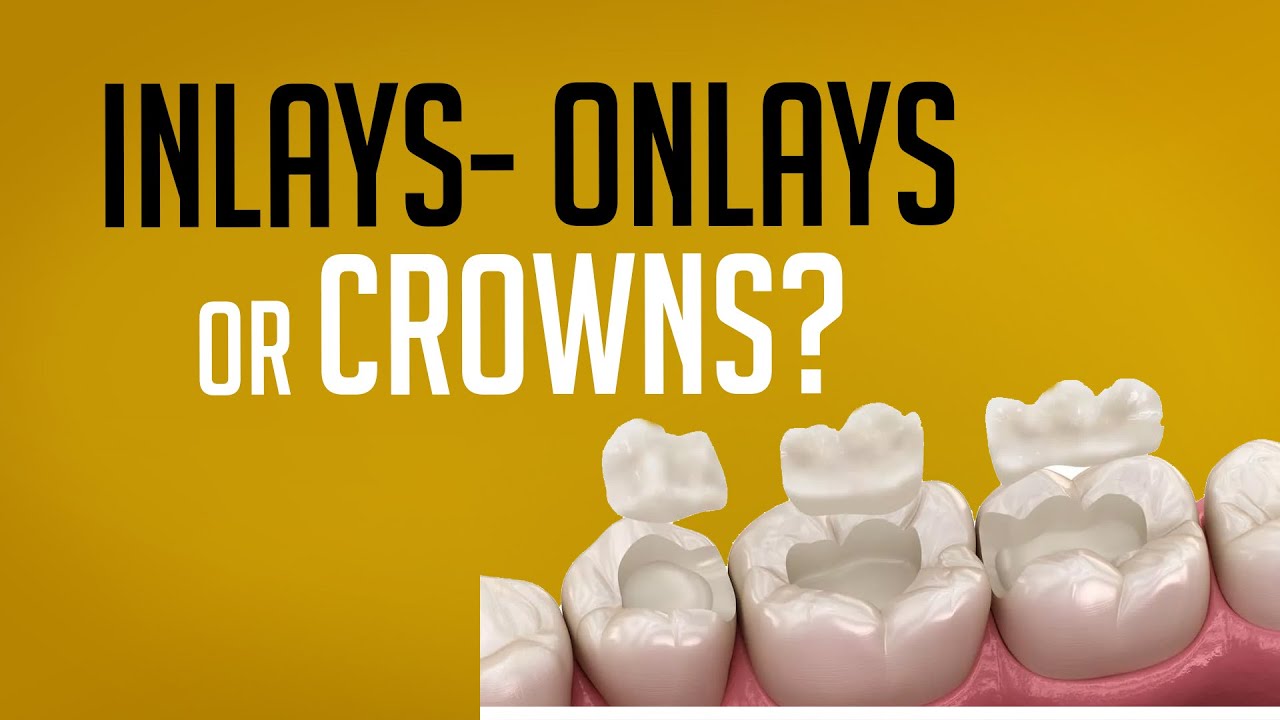 INLAY- ONLAY OR CROWNS? WHICH ONE IS BETTER FOR YOU?