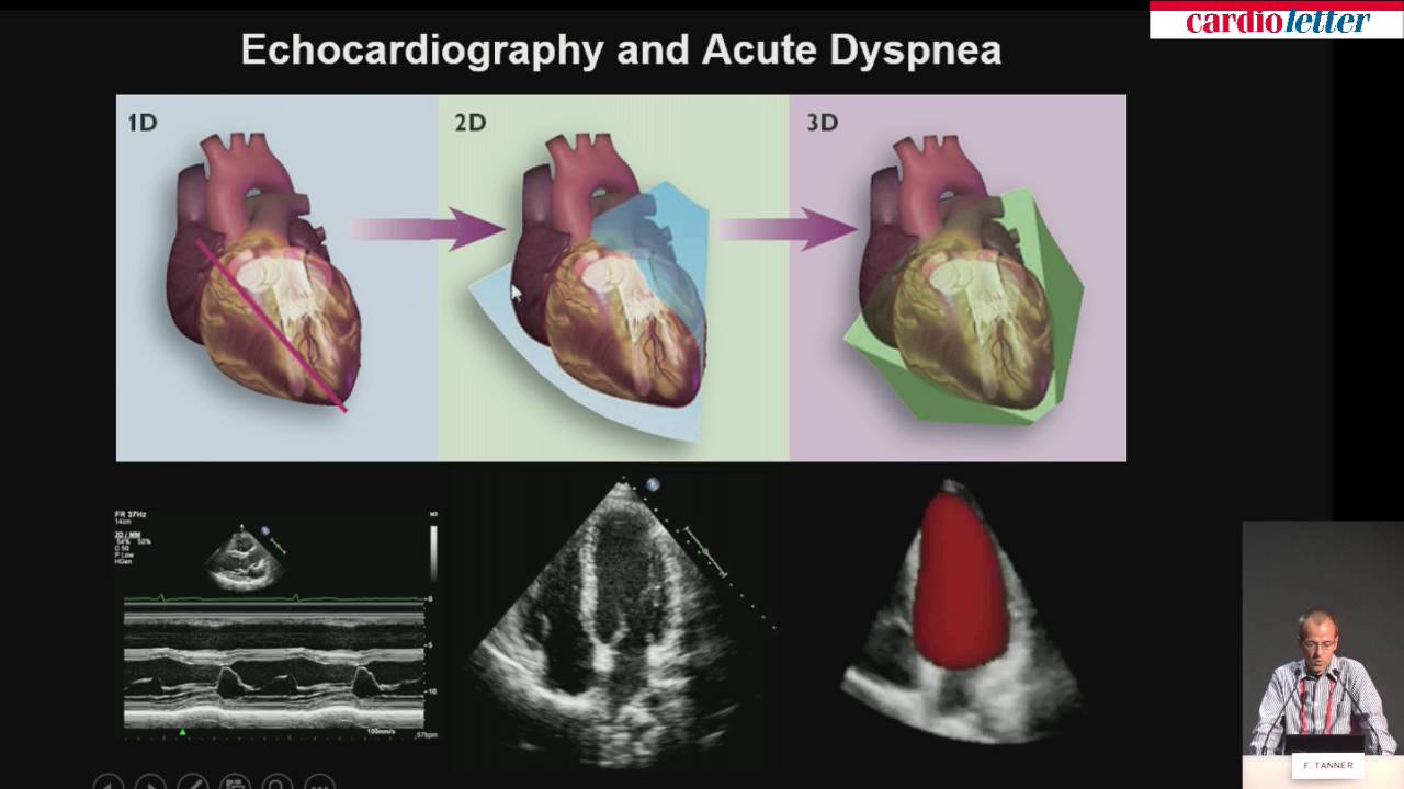 Felix Tanner: Value of cardiac echo in differentiation of acute dyspnea.