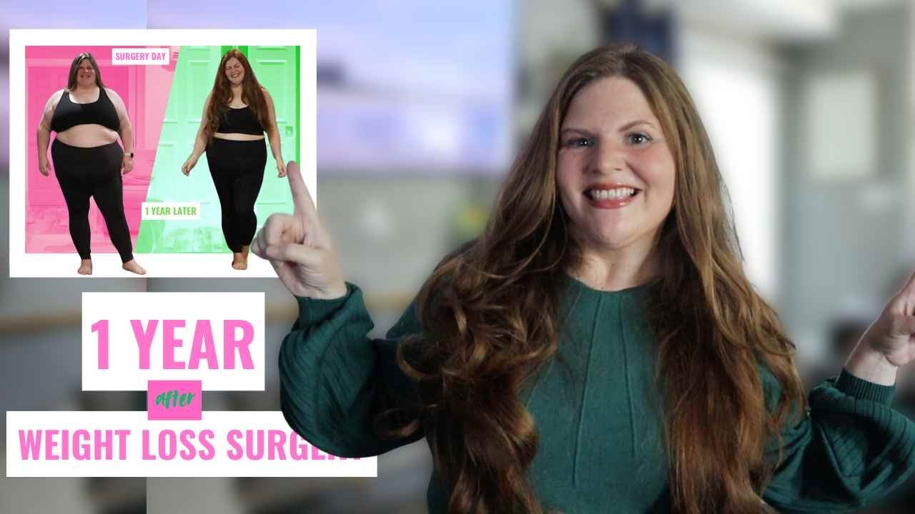 1 year after weight loss surgery and  weight loss results. Worth it or regret the duodenal  switch?