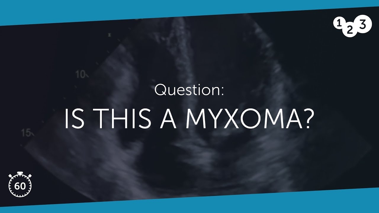 60 Seconds of Echo Teaching Question: Is this a myxoma?