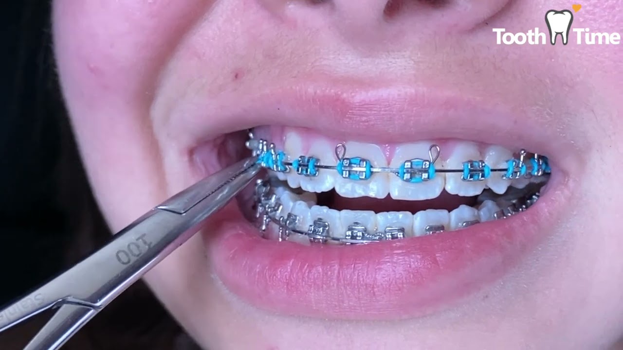 Braces Checkup - Fast Appointment Changing Elastics  - Tooth Time Family Dentistry New Braunfels