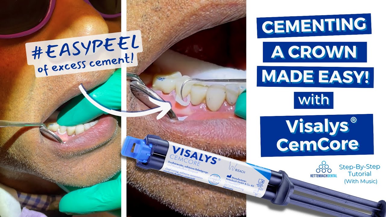 Crown Cementing Made Easy with Visalys&reg; CemCore (Step by Step Tutorial by Dr. Ankur Gupta) #EASYPEEL