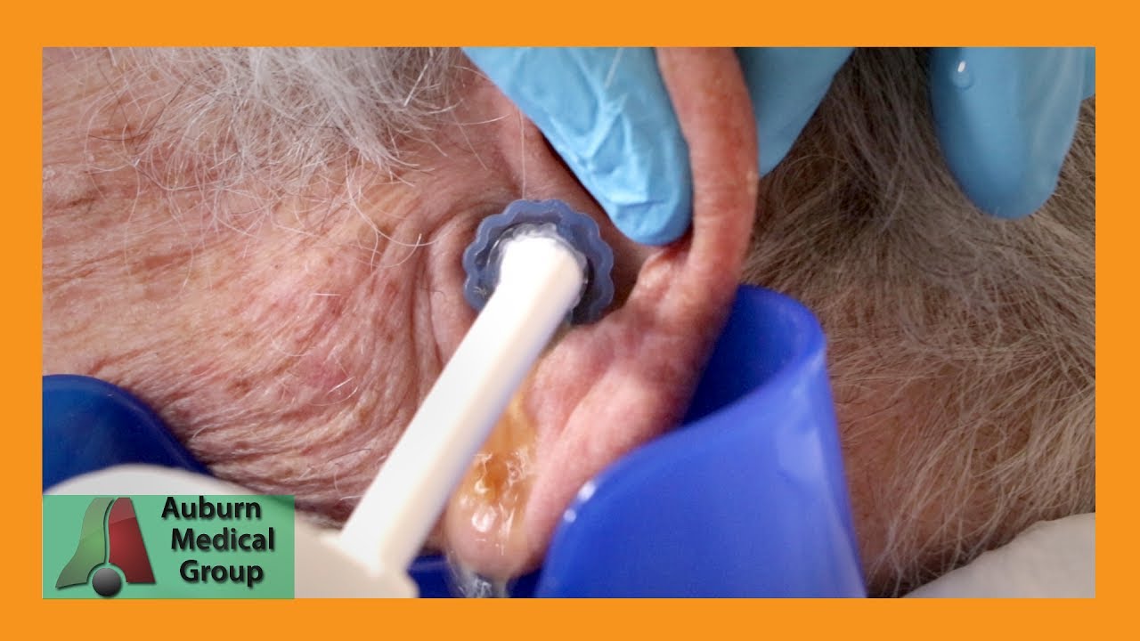 Chuck's Tough Ear Wax Removal Part 2 | Auburn Medical Group