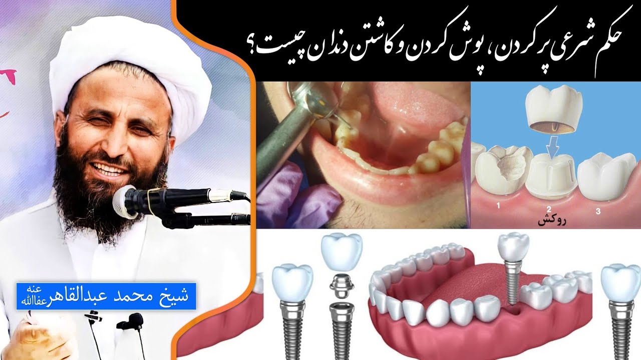 #پرسش_و_پاسخ حکم شرعی پر کردن، پوش کردن، و کاشتن دندان چیست؟  شیخ محمد عبدالقاهر عفاالله عنه
