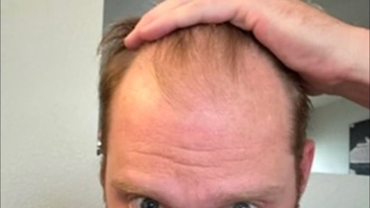 Hair Transplant Month 11 on my trip to Turkey Cosmedica Turkey