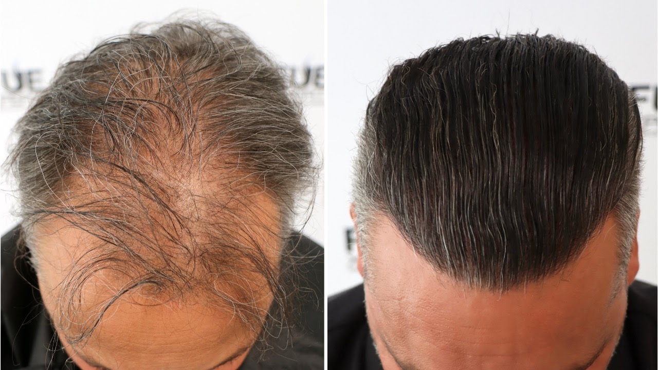 Trasplante Capilar FUE de 3019 injertos por el Dr. Juan Couto en FUEXPERT CLINIC - Madrid, España