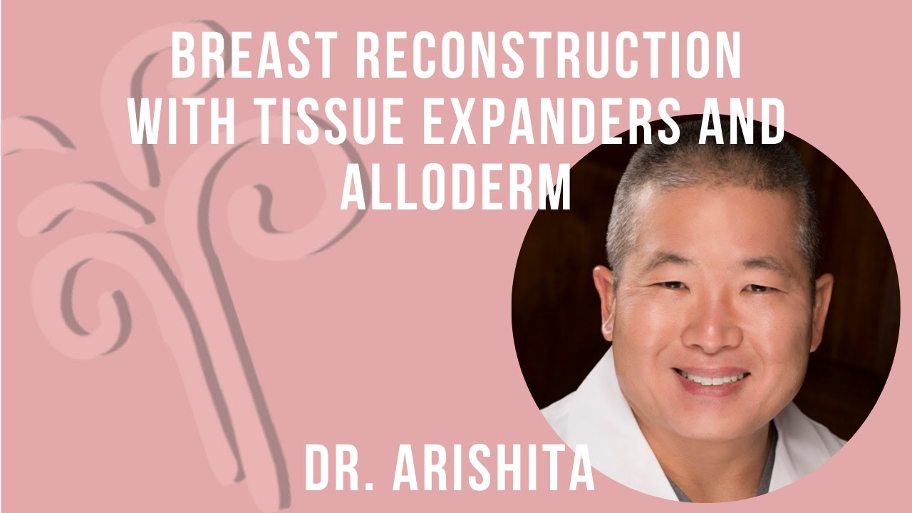 Breast Reconstruction with Tissue Expanders and Alloderm