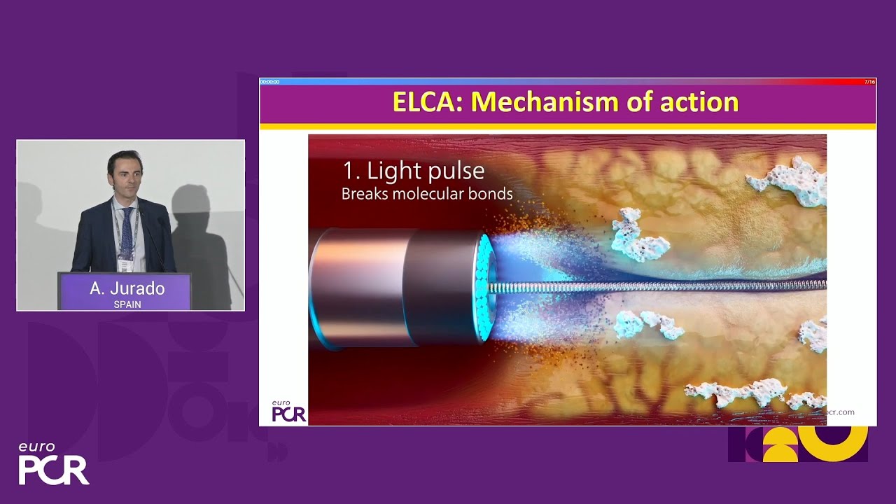 Why should laser atherectomy be part of your complex PCI algorithm? - EuroPCR 2025