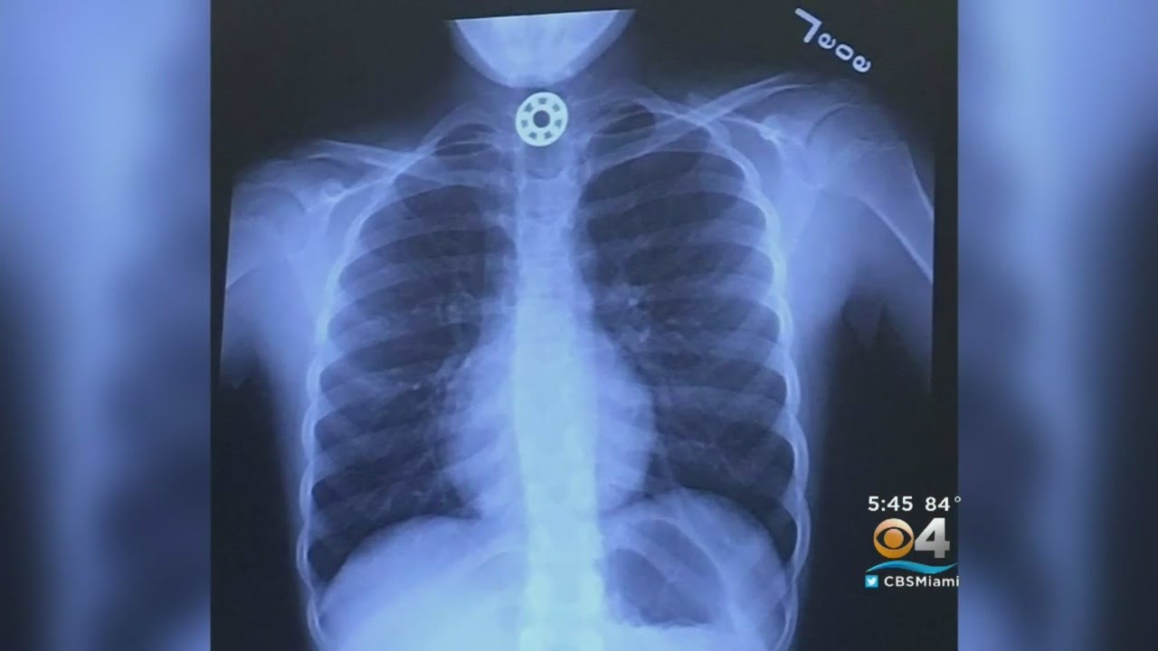 10-Year-Old Chokes On Fidget Spinner