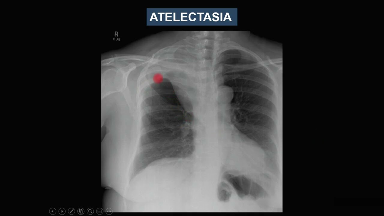 Padrões básicos da doença pulmonar no raio X do Tórax - Aula 4