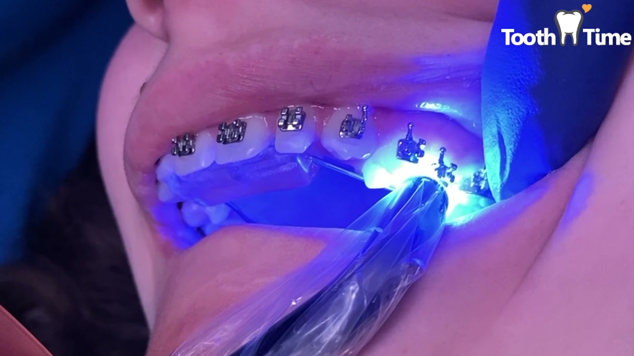 Braces on - 1 Month with a Bite Plate - 19 year old patient - Tooth Time Family Dentistry Texas