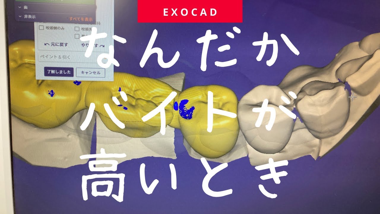 【歯科技工士】なぜかバイトが高い？exocadでCAD／CAM冠作る時の設定