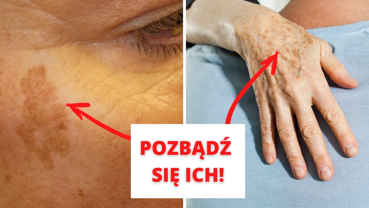 Plamy starcze na twarzy możesz usunąć domowymi sposobami - Zobacz JAK