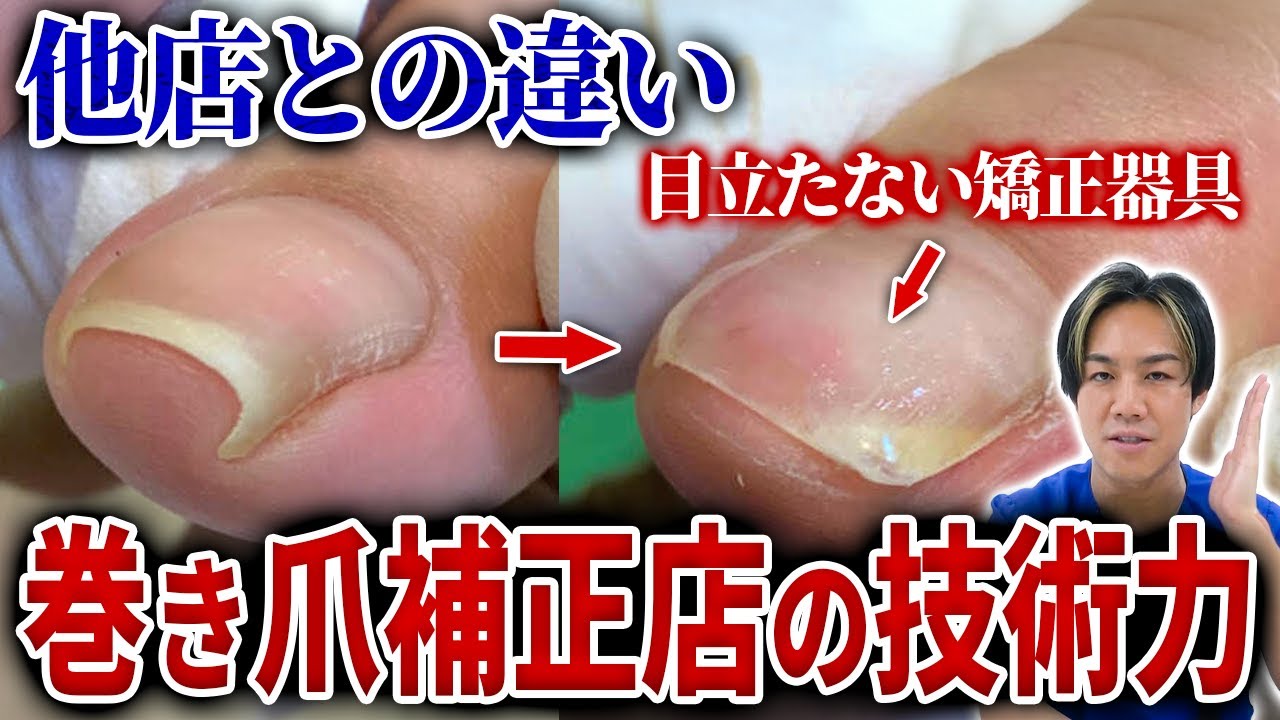 時間・お金・労力を無駄にしないで！爪のトラブルで迷ったら絶対に巻き爪補正店に来て！