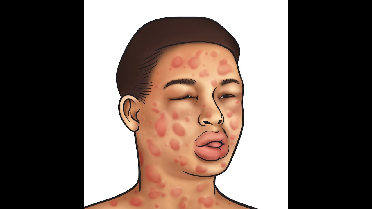 Soy Allergy Symptoms