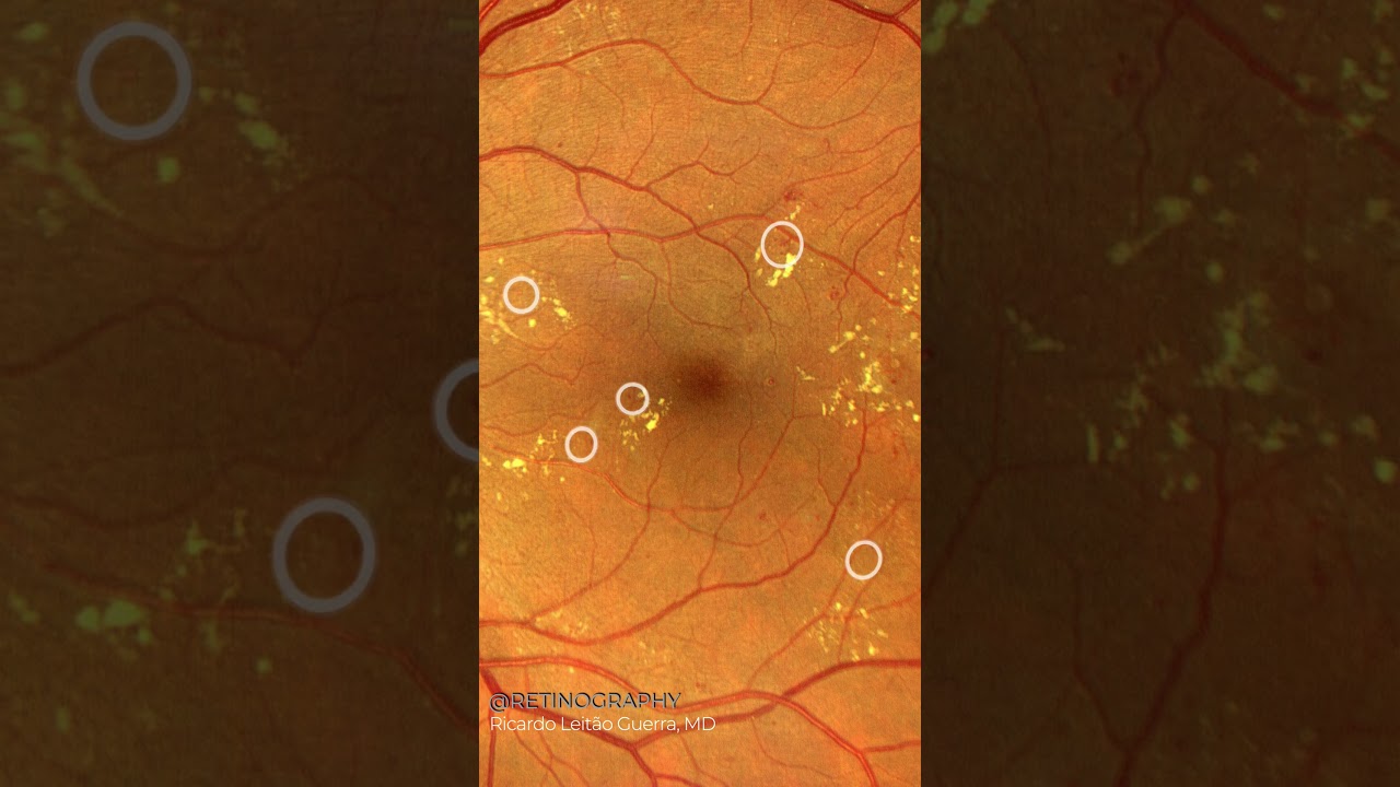 Diabetic retinopathy - microaneurysms
