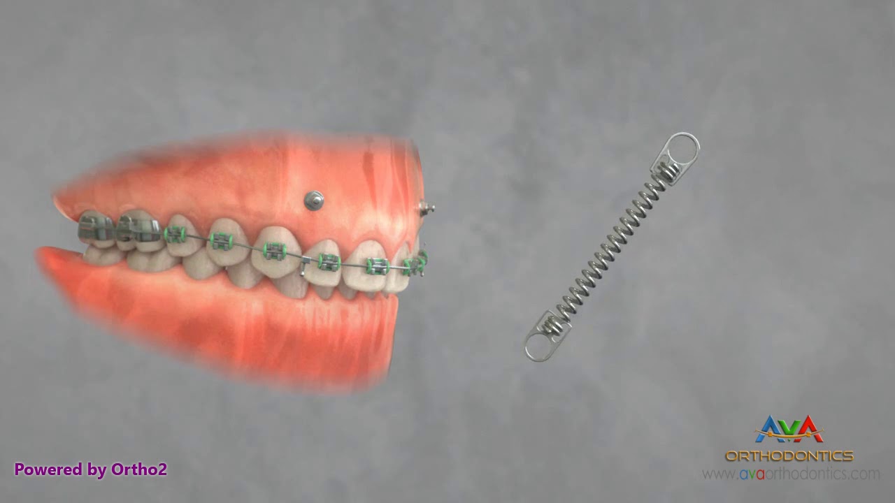 Orthodontic Treatment for Gummy Smile - TAD and Coil Spring
