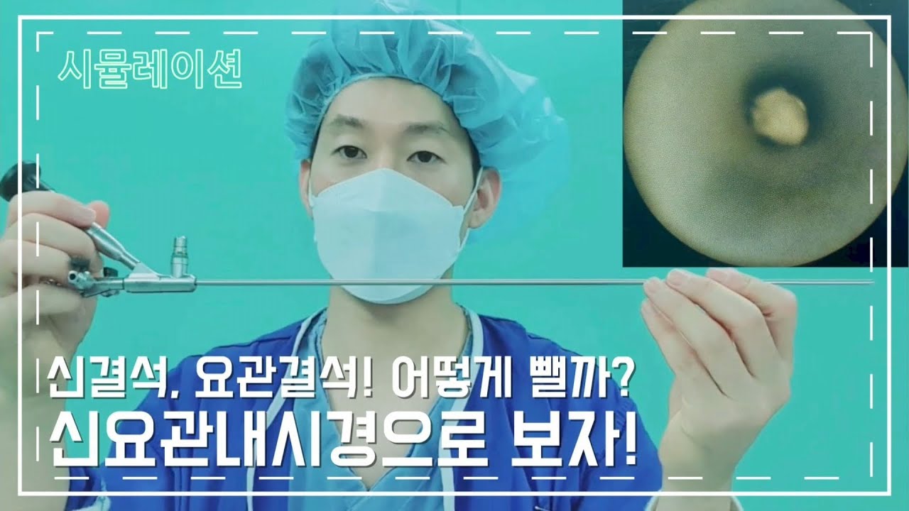 신요관내시경으로 보는 신결석, 요관결석! 내시경 비교분석영상과 함께하는 결석제거영상 feat. 시뮬레이션