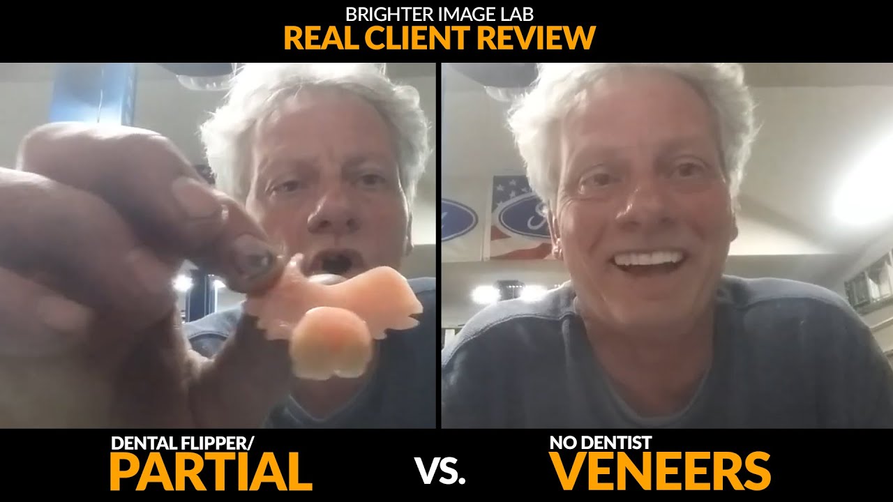 Dental Partial / Flipper vs. No Dentist Veneers- MUST WATCH- Brighter Image Lab Real Client Review