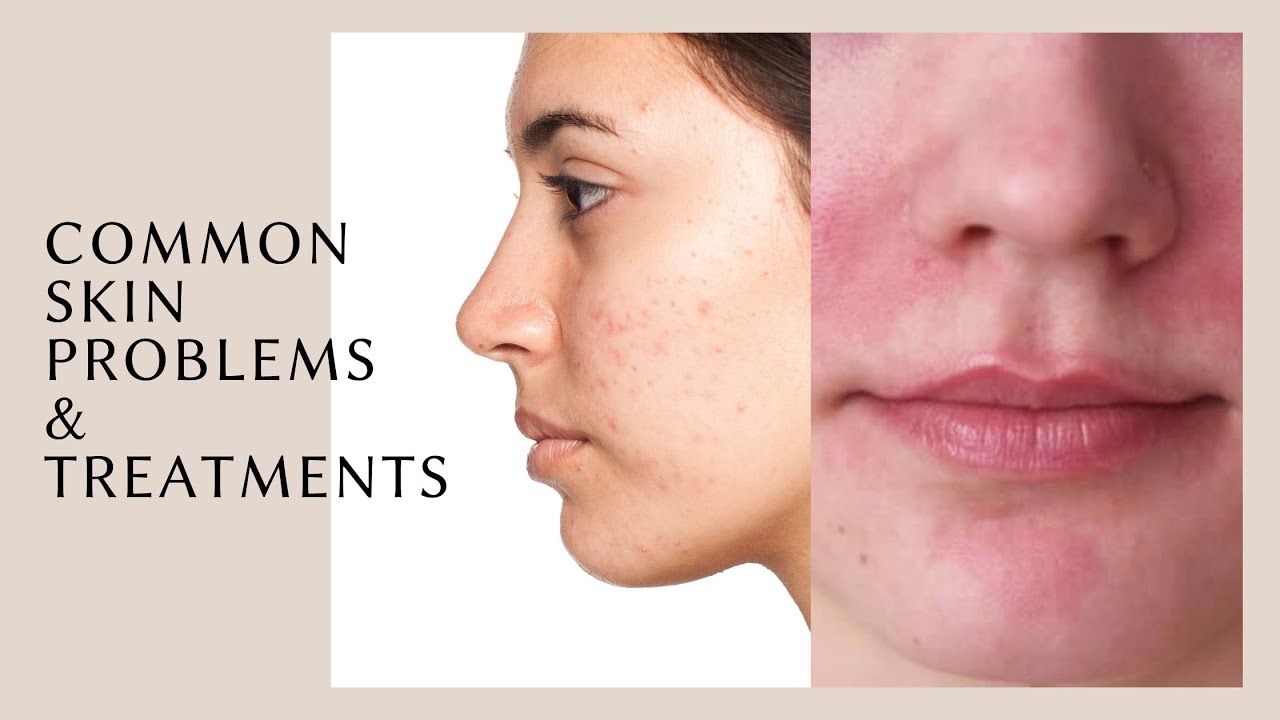 TUTORIAL  Common Skin Problems You'll See as an Esthetician