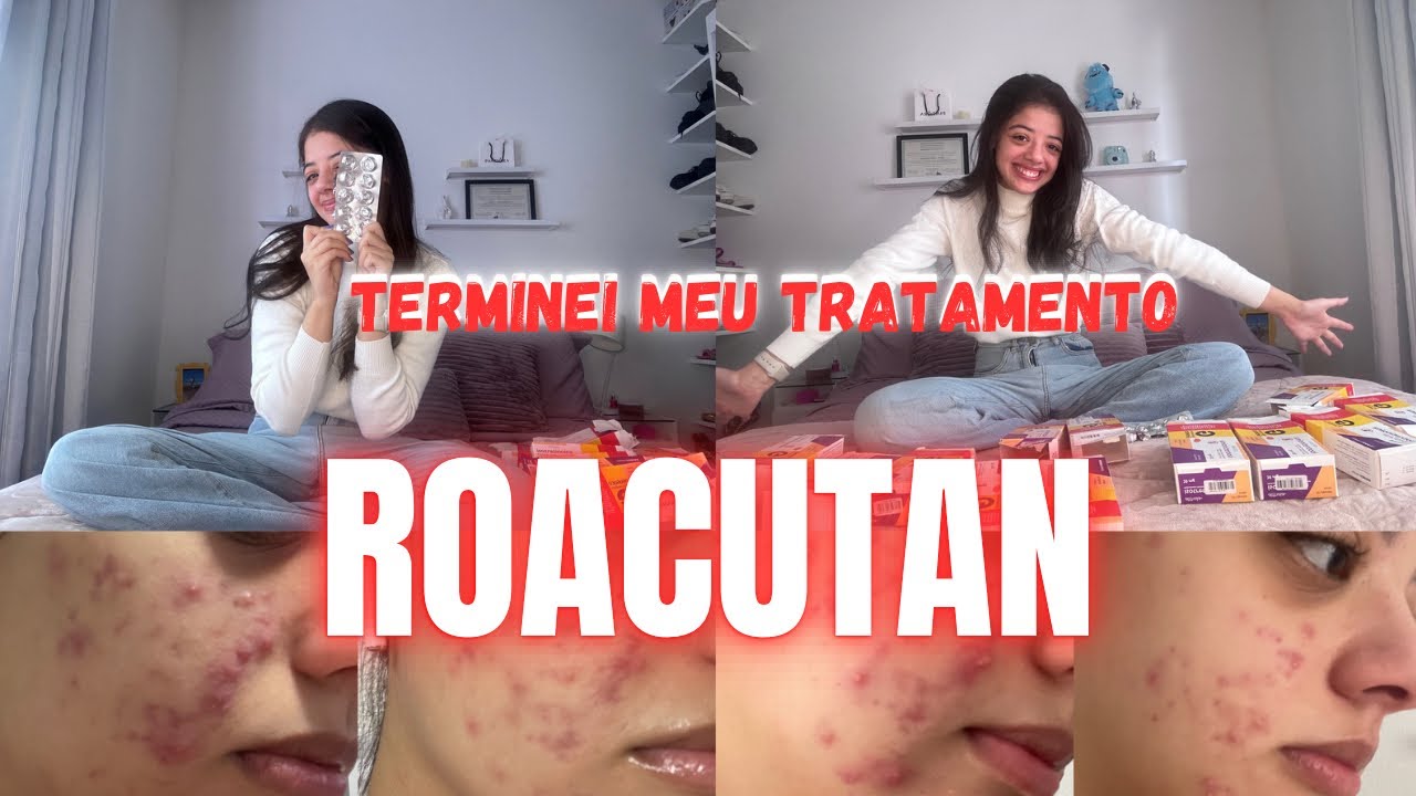 TERMINEI MEU TRATAMENTO COM ROACUTAN! Sintomas, produtos e fotos do processo