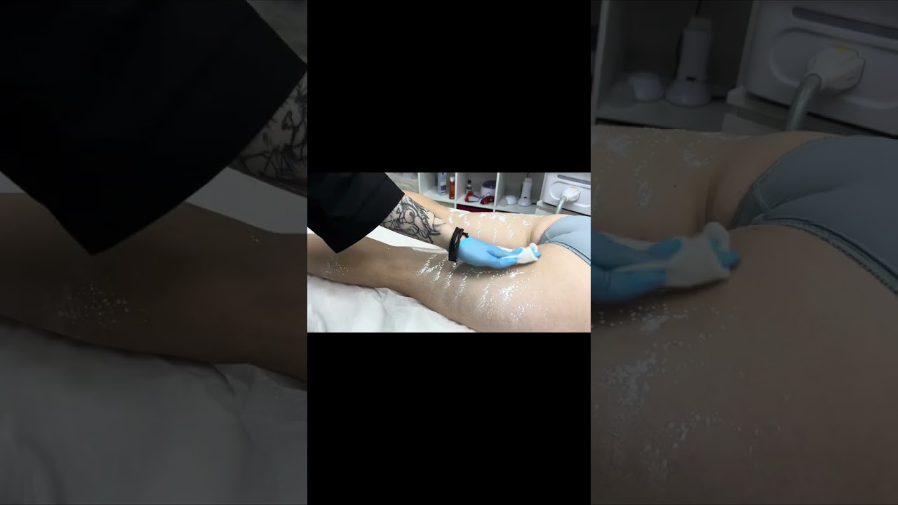 Восковая депиляция бедер ног в студиях депиляции WAX BAR (картриджный воск Italwax Flex)