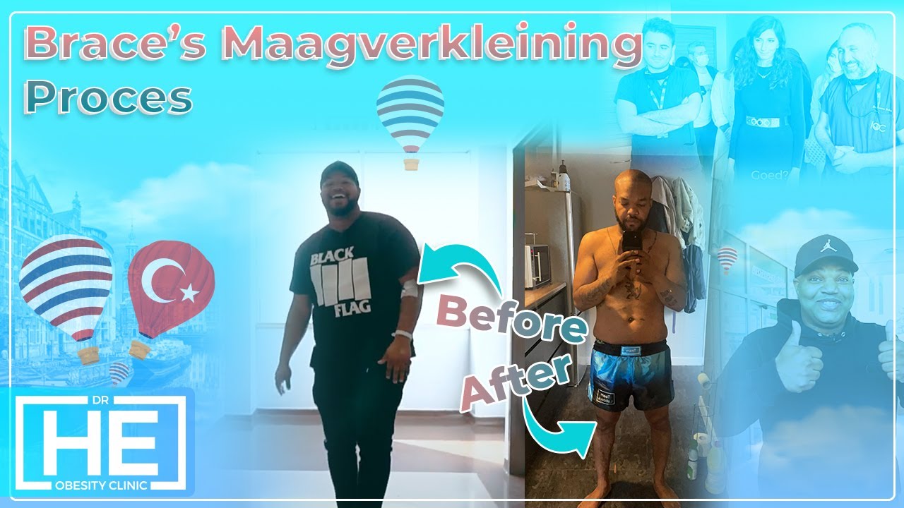 Maagverkleining in Turkije | Brace is 33 Kilo Afgevallen in 8 Maanden Tijd!