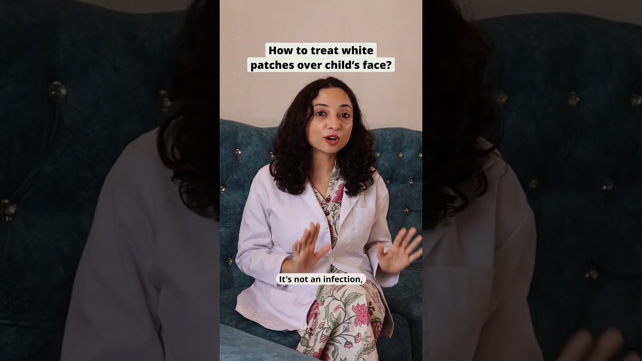 How to treat white patches over a child&rsquo;s face? #SkinCareForKids #PityriasisAlba