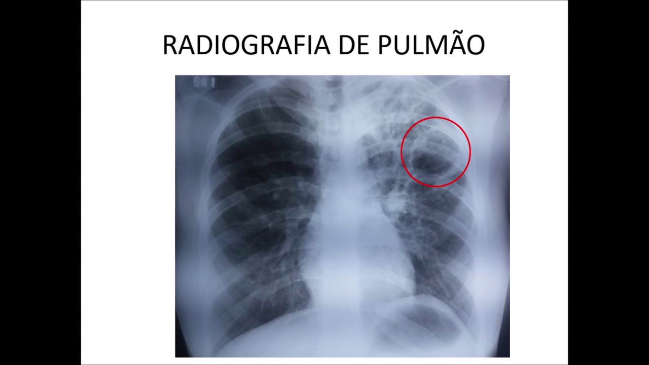 Curso de Radiologia de Tórax: Aula V