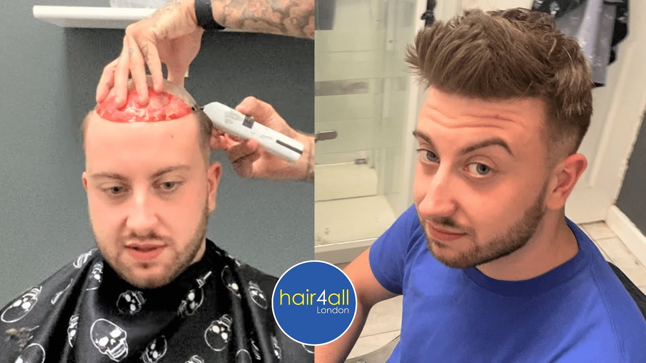 Before & After | Hair System | Non-Surgical Hair Replacement System Men/Women | UK/USA/International