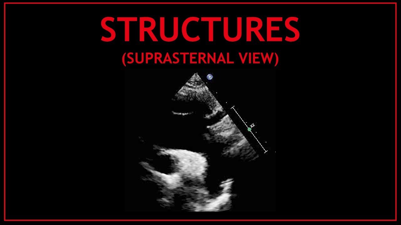 Cardiac STRUCTURES! (Suprasternal view) - Echocardiography
