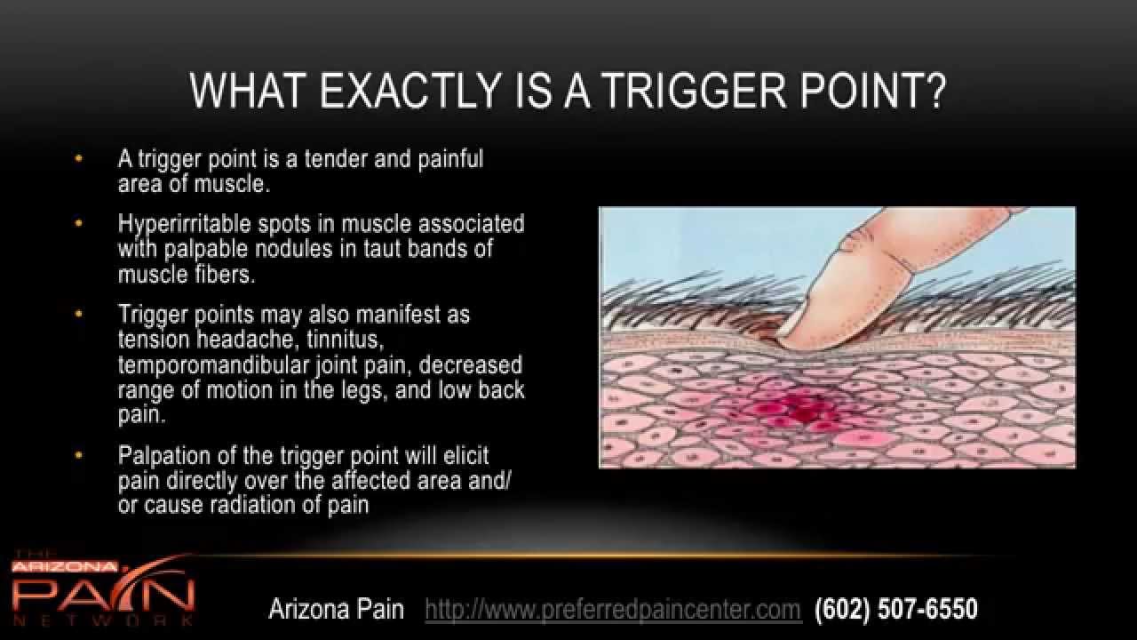 Trigger Point Injections - What You Need to Know