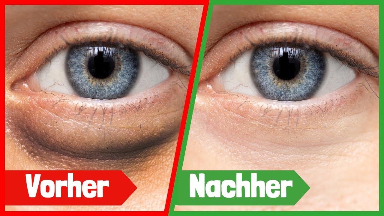 So wirst du mit diesem einfachen Hausmittel Augenringe los