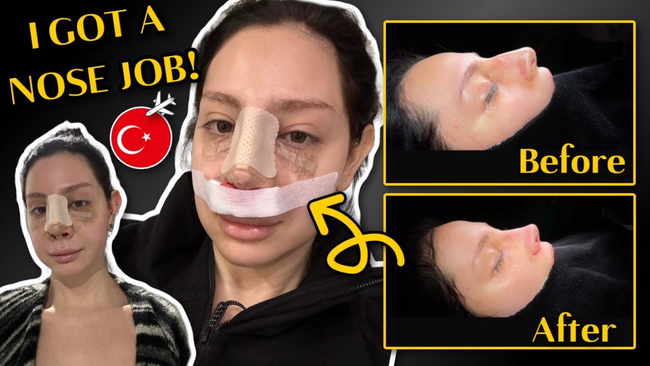 NOSE JOB AT THE BEST DOCTOR IN TURKEY! + RHINOPLASTY ESSENTIALS HAUL | Dr.serifyavuz